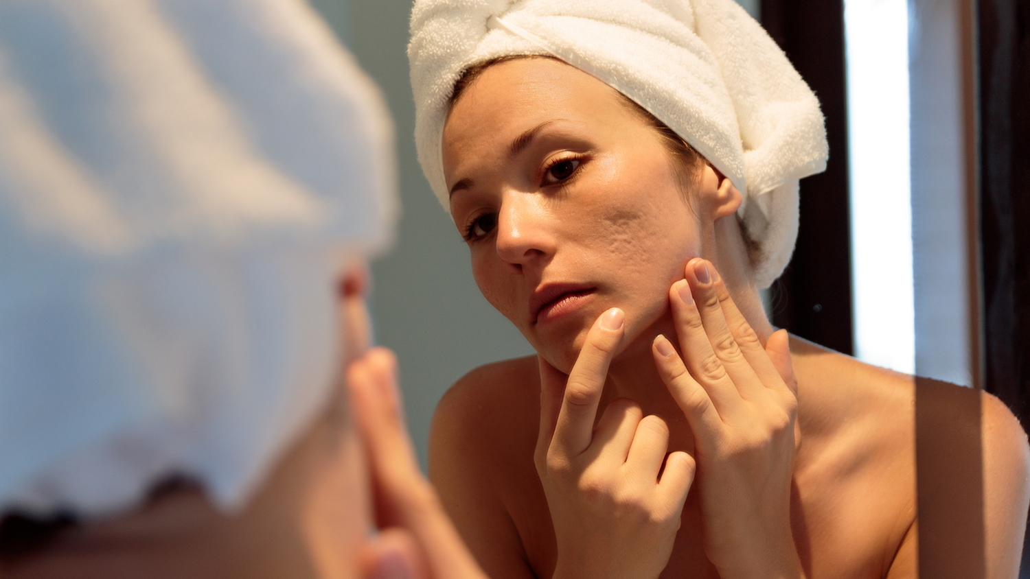 L'acné hormonale : origines, causes, prévention et traitements naturels